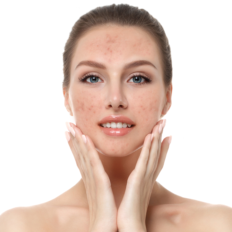 Skin treatment — before treatment